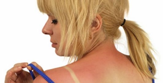 خلطات لتخفيف الحروق الناجمة عن أشعة الشمس