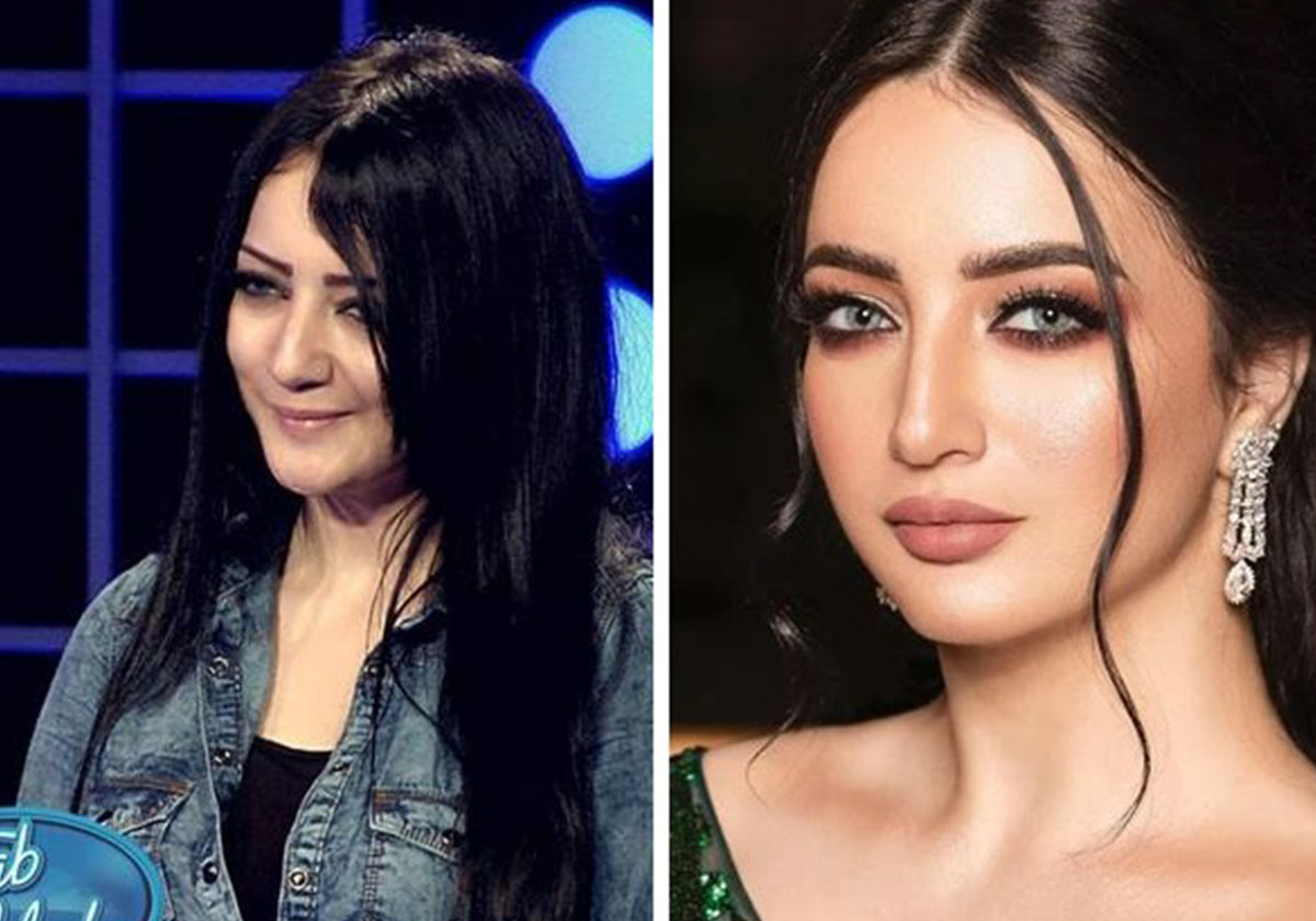 منال موسى قبل التجميل وبعده
