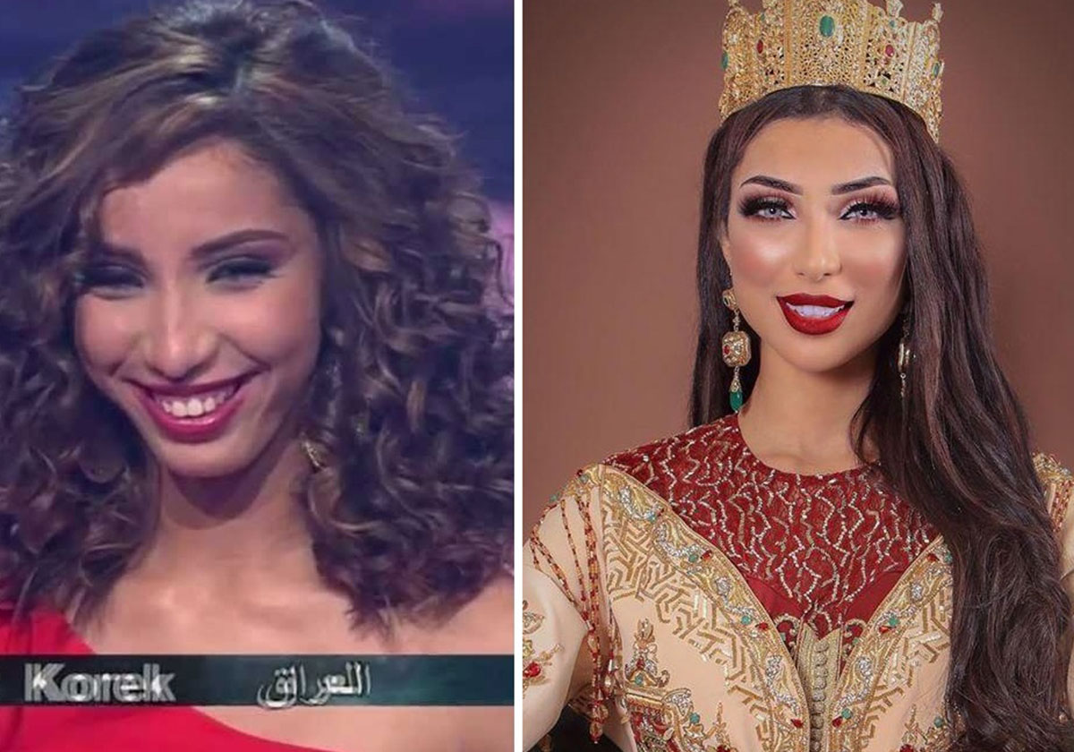 دنيا بطمة قبل التجميل وبعده