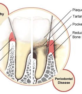 teeth-periodontal-disease-10-8-2010