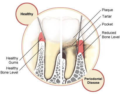 teeth-periodontal-disease-10-8-2010