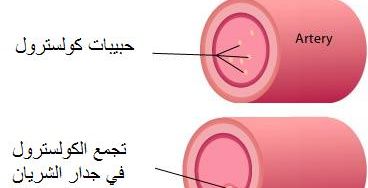 تصلب الشرايين: تعريف وأسباب