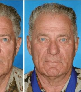 التقدم في السن بان واضحاً على بشرة التوأم المدخن