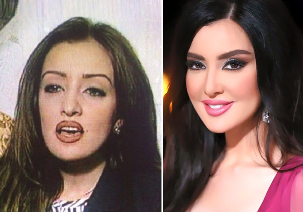 ميساء مغربي قبل التجميل وبعده