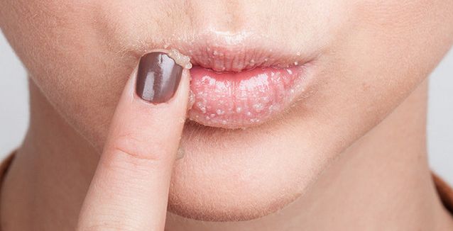 خلطات منزلية طبيعية لعلاج تقشر وجفاف الشفايف