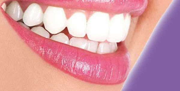 تبييض الأسنان