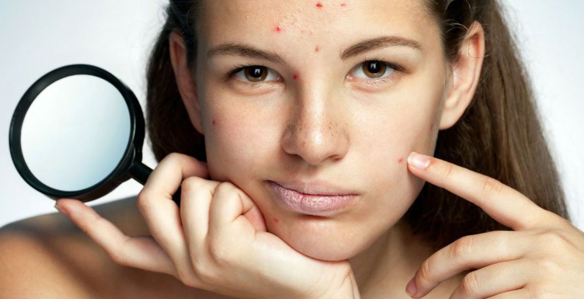 أطعمة غير متوقعة تسرّع علاج حبّ الشباب