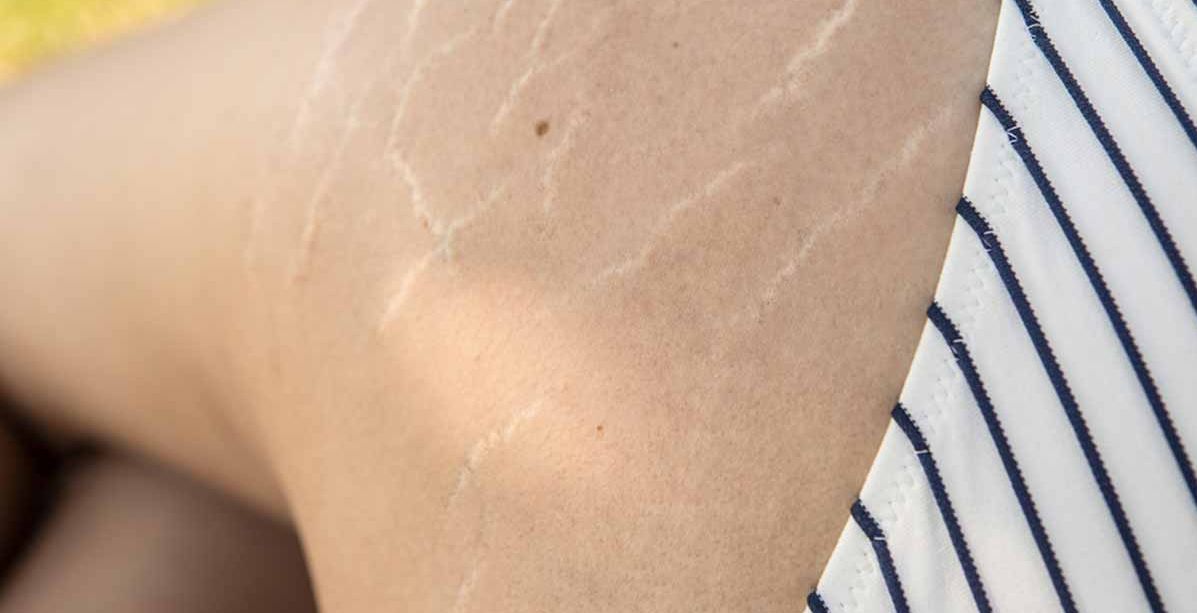 لا يمكنك تحمل الخطوط البيضاء في جسمك؟ إليك هذه الخلطة السحرية للتخلص منها