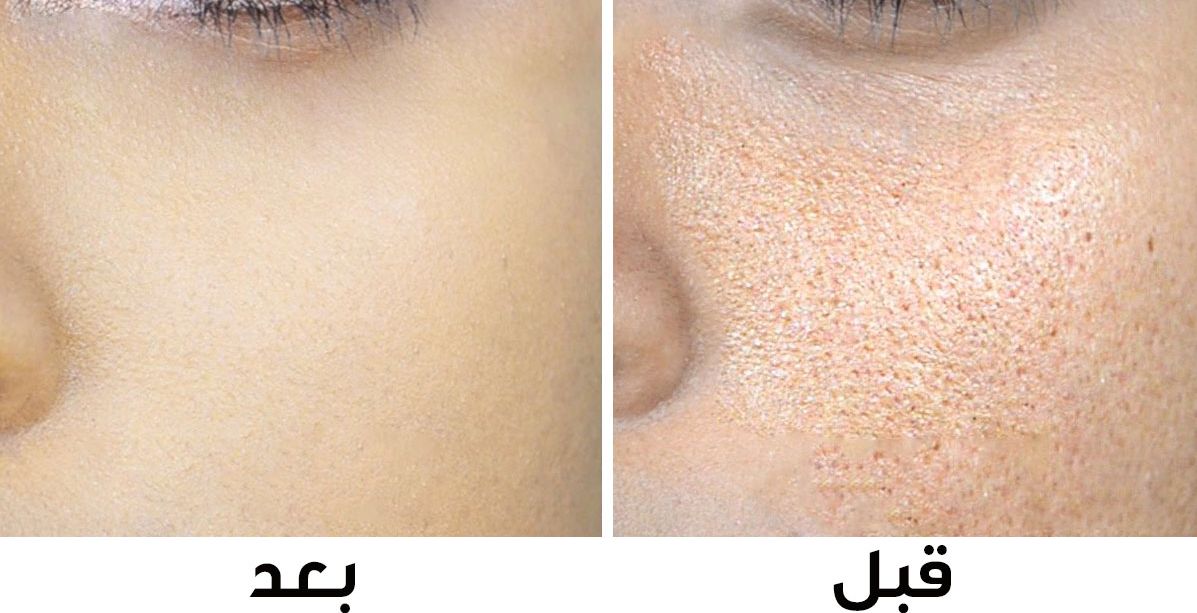 هكذا تتخلصين من المسام الواسعة بنصف ساعة!