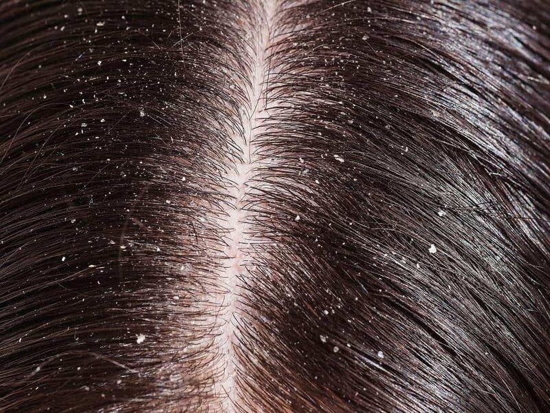 انواع قشرة الشعر بالصور