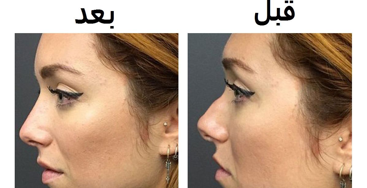 طبقي هذه الخلطة لمدة 30 دقيقة يومياً... واحصلي على أنف صغير ونحيف في وقت قياسي!
