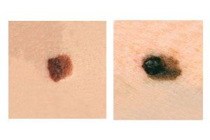 اختبار الدقيقتين الذي أنقذ أكثر من 20% من القراء من مرض سرطان الجلد!