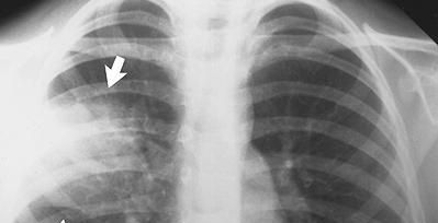 تقنية جديدة للكشف المبكر عن سرطان الرئة