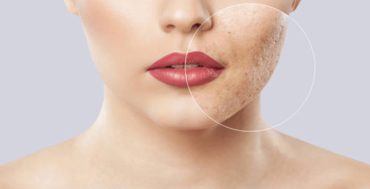 أطعمة تحارب بثور الوجه والجسم