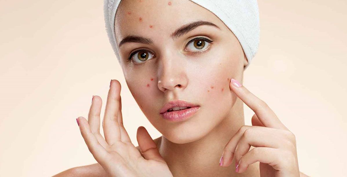 خلطات للتخلص من الحبوب في الوجه