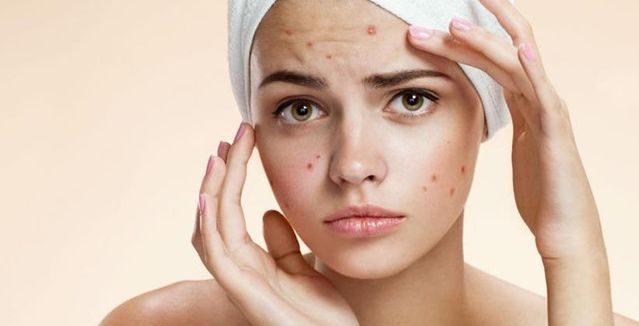 افضل خلطة حب الشباب