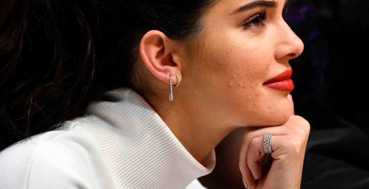 نجمات يعانين حب الشباب ويخفينه بالمكياج