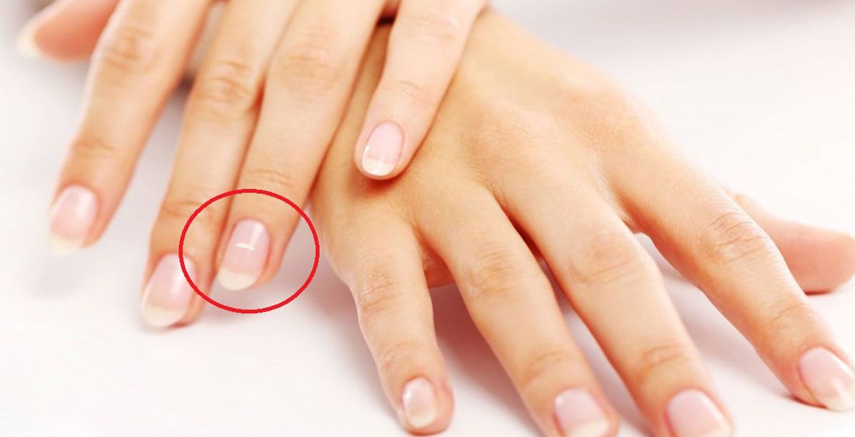 هذا هو السبب الحقيقي لظهور البقع البيضاء على الاظافر؟