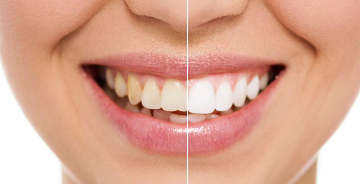مكوّن طبيعي يبيّض أسنانك في يوم واحد