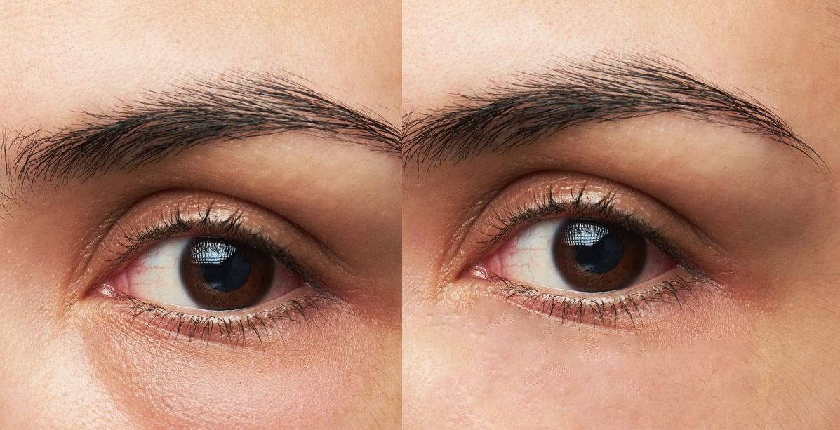 خلطة القرفة للقضاء على الجيوب المنتفخة تحت العينين!