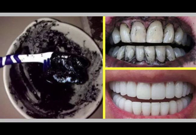 الفحم لتبييض الأسنان