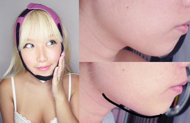 إزالة الذقن المزدوج قبل وبعد