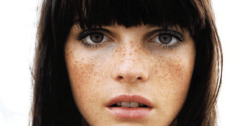 5خلطات طبيعيّة لإزالة النمش