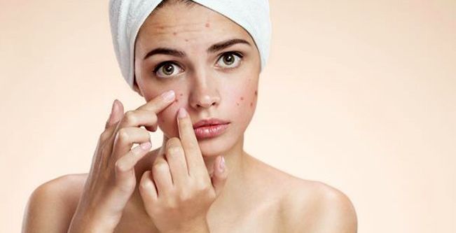 خلطات طبيعية لعلاج اثار حب الشباب