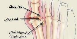 داء النقرس: تعريف وأسباب 