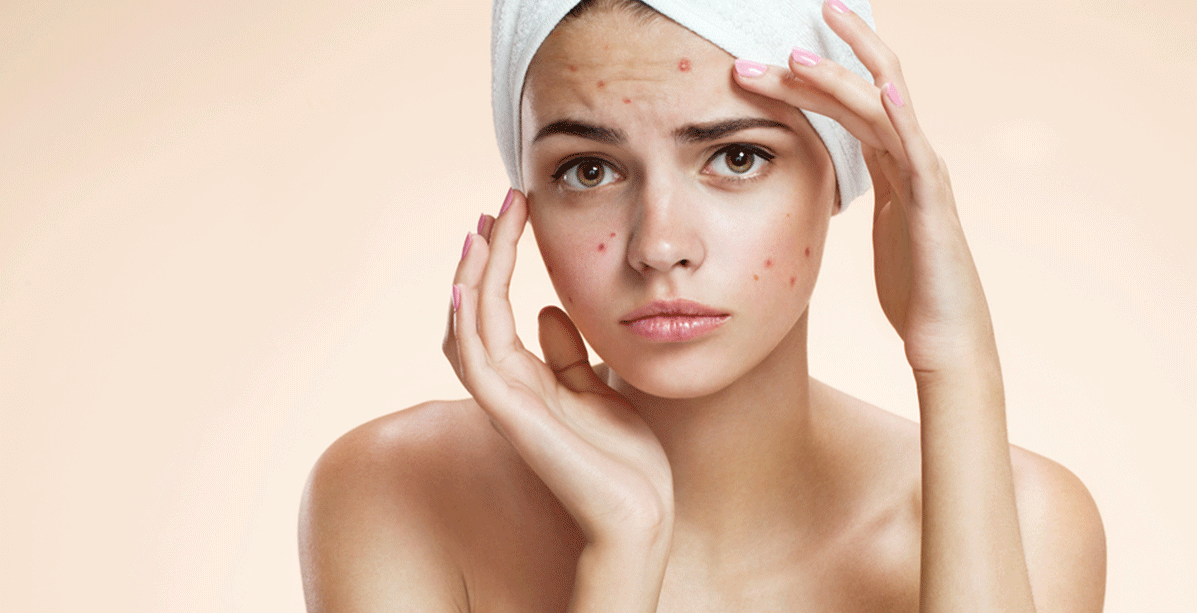 5 اشياء عليك تجنبها في علاج حب الشباب