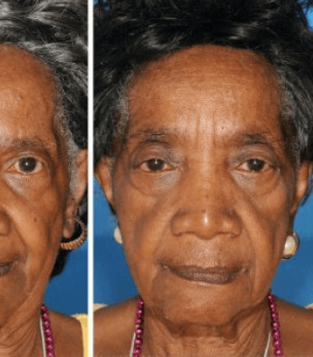 التجاعيد والهالات السوداء تحت العين بسبب التدخين