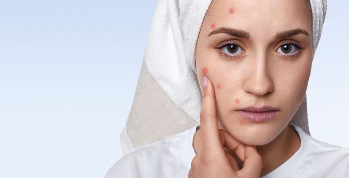 حبوب الروكتان للتبييض