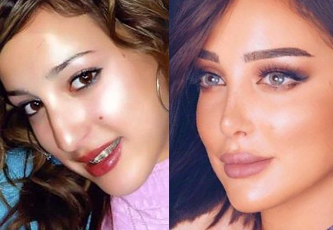 بسمة بوسيل قبل بعد عملية تجميل الأنف