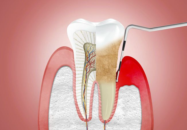 ما علاقة فايروس كورونا بخسارة الأسنان؟