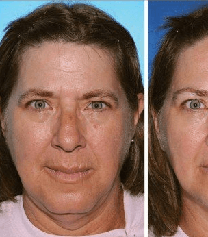 بشرة الوجه تفقد رونقها بسبب التدخين