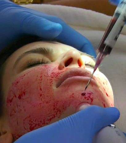 كيم كارداشيان خلال عملية شد الوجه 