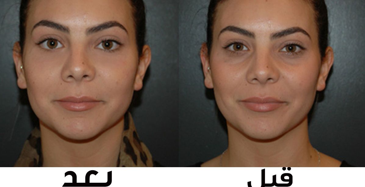 للقضاء على التجويف والتجاعيد حضري فيلر العين الطبيعي بنوعين من الخضار فقط!