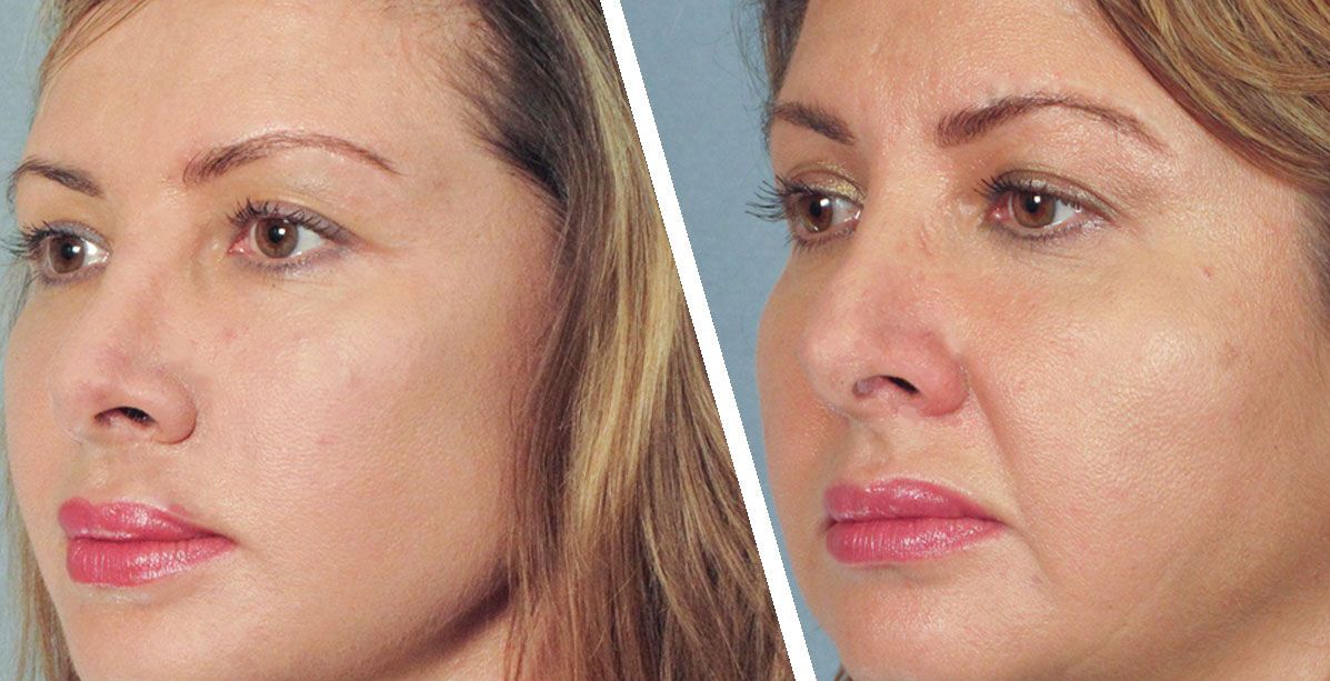 شدي بشرتك بدون جراحة وتخلصي من تجاعيد الفم بنصف ساعة!