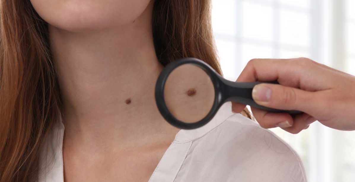 امور تكشفها الشامة عن شخصيتك حسب موقعها في جسمك