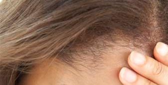 الإمعان في التفكير مرتبط بالإكتئاب وفقدان الذاكرة