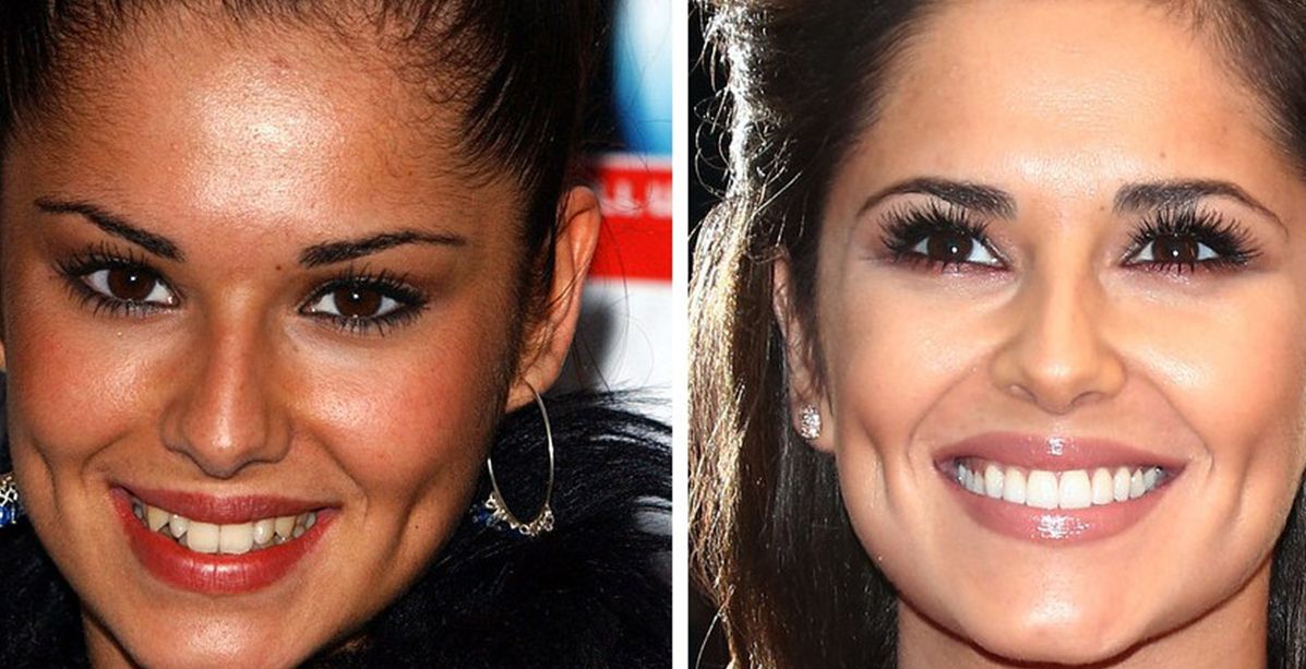 النجمات وتجميل الأسنان...صور تظهر التغييرات المذهلة! 