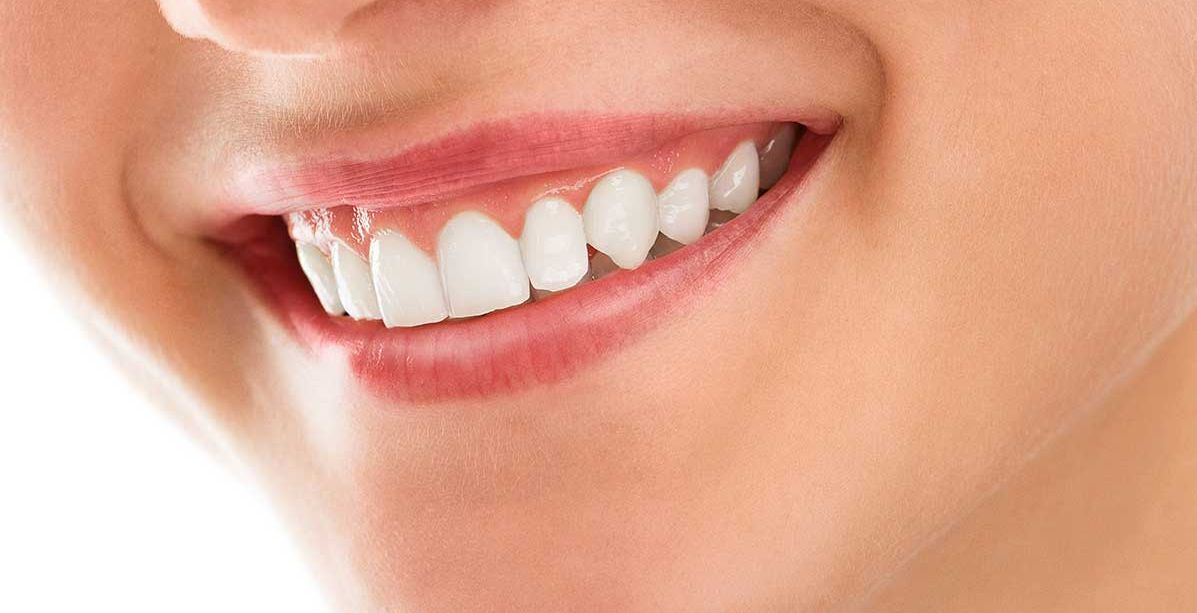 تبييض الاسنان في اسبوعين