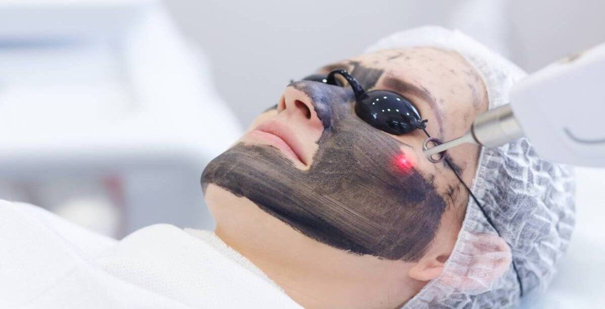 الليزر الكربوني للتصبغات