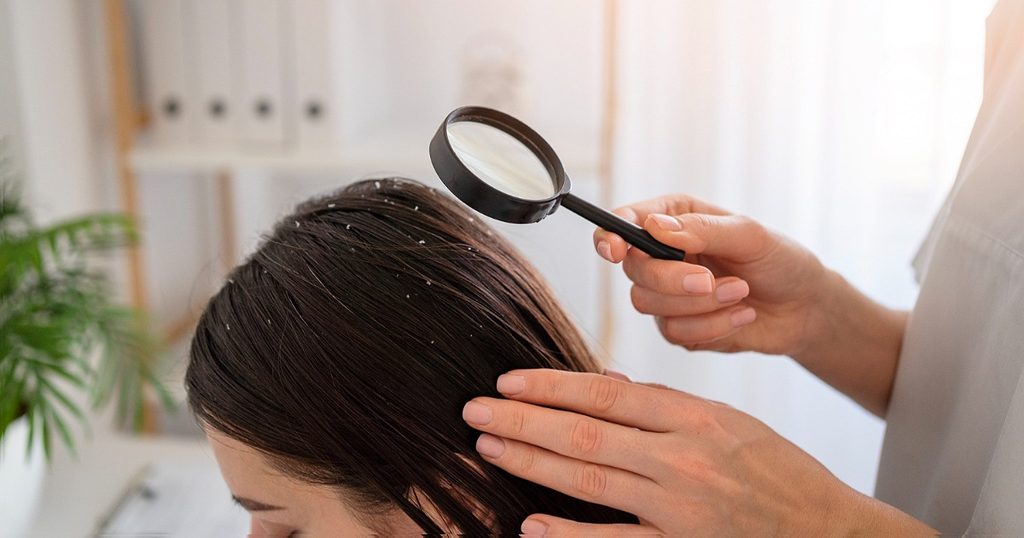 طريقة التخلص من القشرة