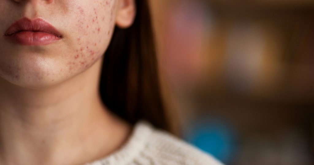 التخلص من حب الشباب