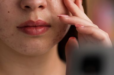 أسرع علاج تورم الوجه بسبب الحساسية