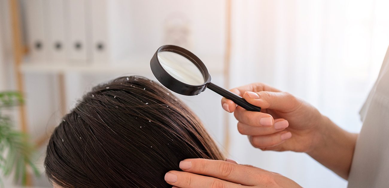 كيفية التخلص من قشرة الشعر السميكة