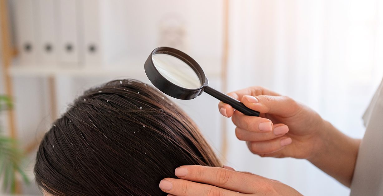 كيفية التخلص من قشرة الشعر السميكة