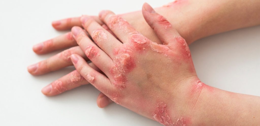 عوارض أكزيما اليدين