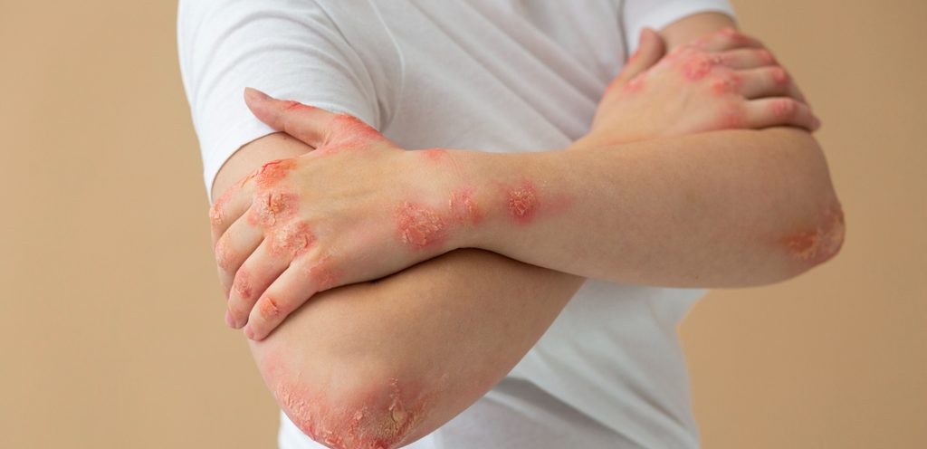 علاج الأكزيما
